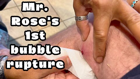 Mr Rose's #2023 bubble pop, was it a sign for #2024, or just a #cyst rupturing?🤮 #shorts