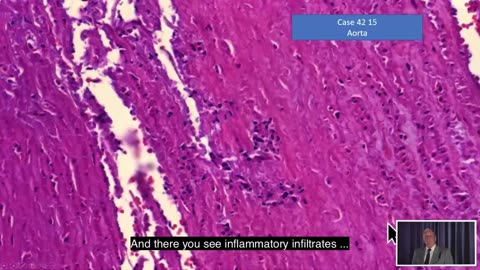 Aortic Dissection Caused By Covid Vaccine: Pathologist Arne Burkhardt (02)