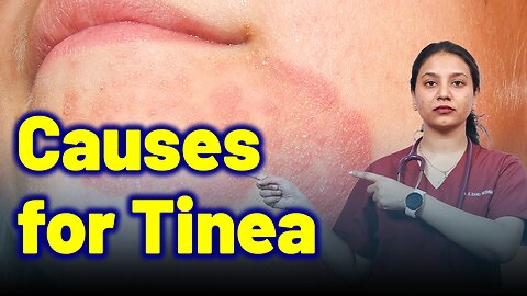 Important Causes of Tinea . | Treatment Cure Relief Medicine | Skin Hair Nail | Homeopathy