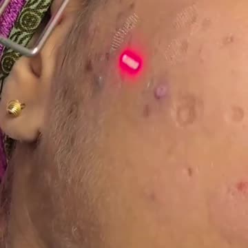 Achieve Smoother Skin with CO2 Fractional Laser Scar Reduction