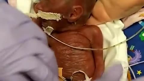 WOW! Premature baby Born at 22 Weeks!