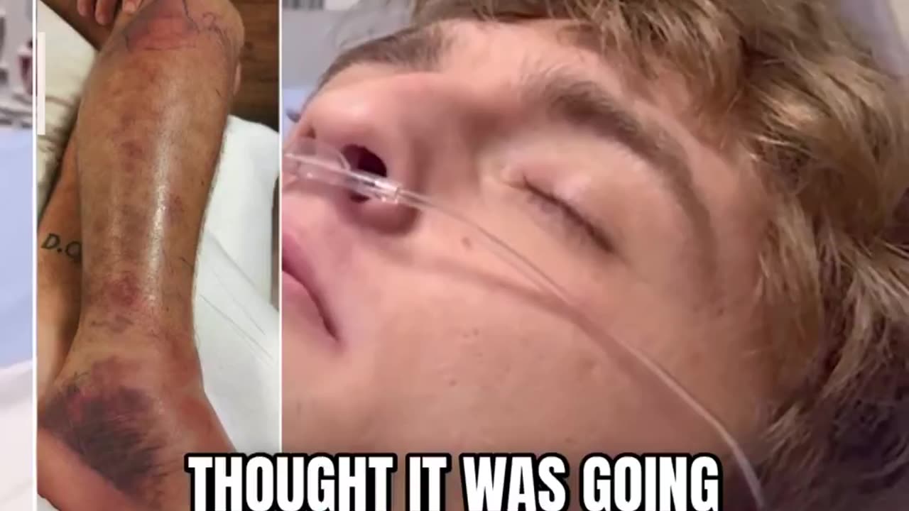 Florida Man Accepts His Fate After Being Bitten By A Diamond Back Snack