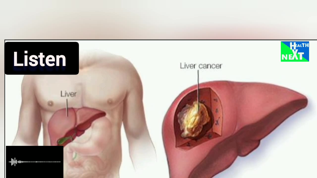 Liver cancer cancer causes, prevention and treatment