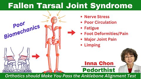 Fallen Tarsal Joint Syndrome