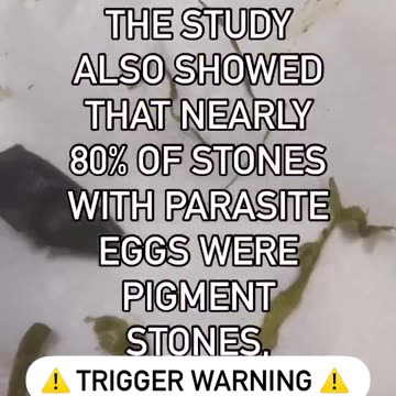 Turns out that gall stones are more often than not, a parasite from the liver called a fluke