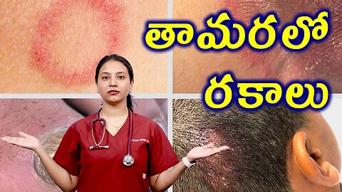 తామరలో రకాలు ఎన్ని? Types of Tinea or Ringworm Homeopathy Treatment Cure Medicine Cure | హోమియోపతి