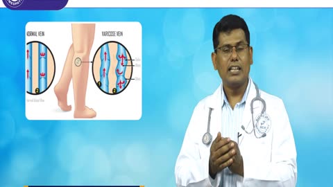 Varicose Viens homeopathy treatments in Bangalore | Rich care Homeopathy