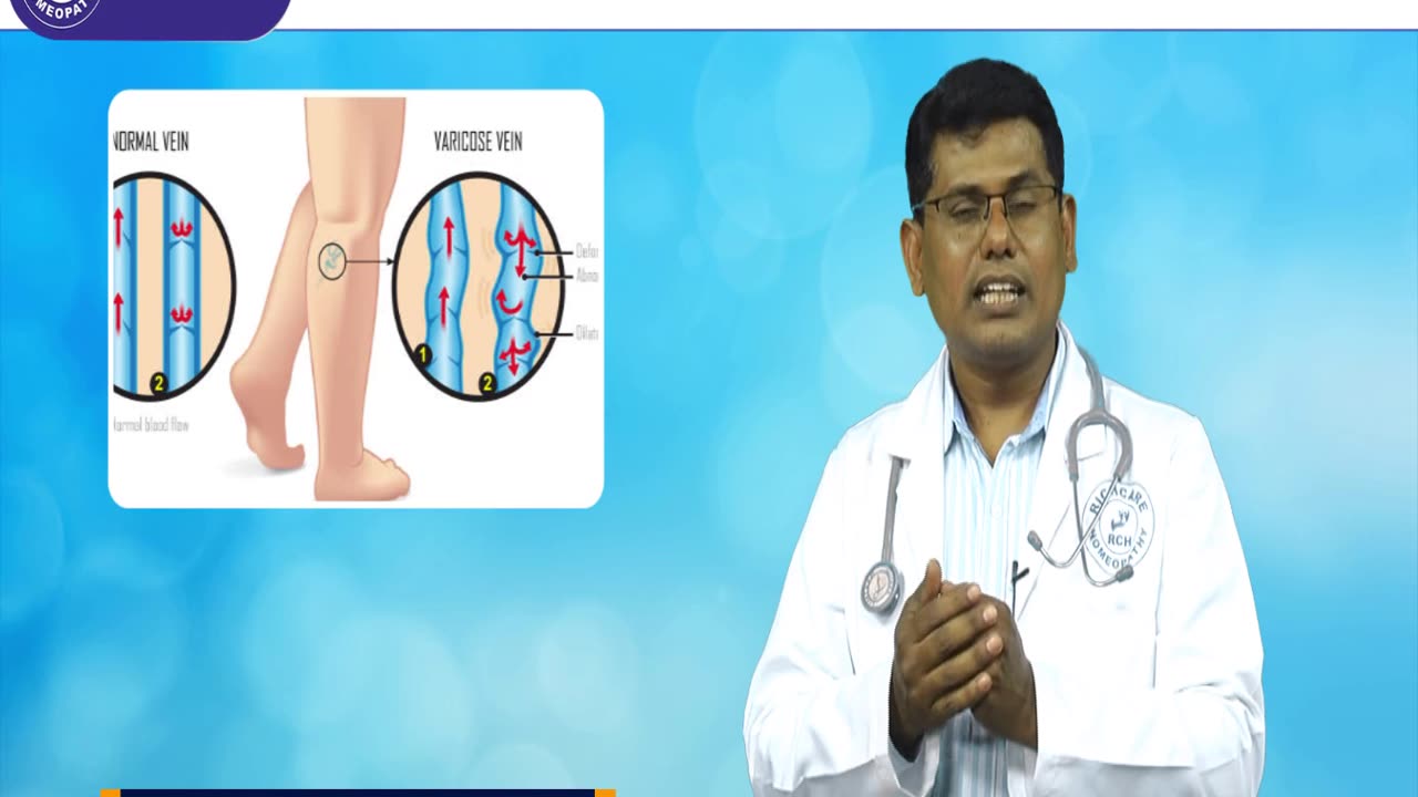 Varicose Viens homeopathy treatments in Bangalore | Rich care Homeopathy