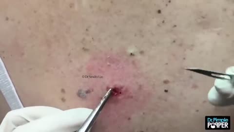 Dr Pimple Popper vs THE BIG ONE