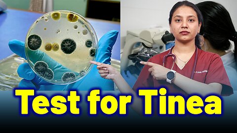 Test for Tinea . | Treatment and Cure | Homeopathy, Medicine & Surgery