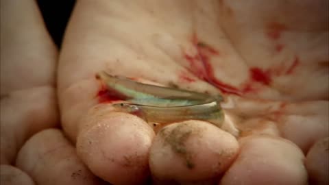 Removing A Candiru From Man's Penis | HORROR STORY | River Monsters