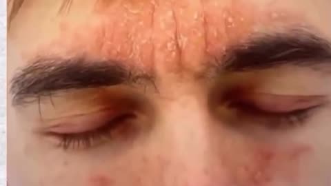 Skin conditions are often liver overload or parasites