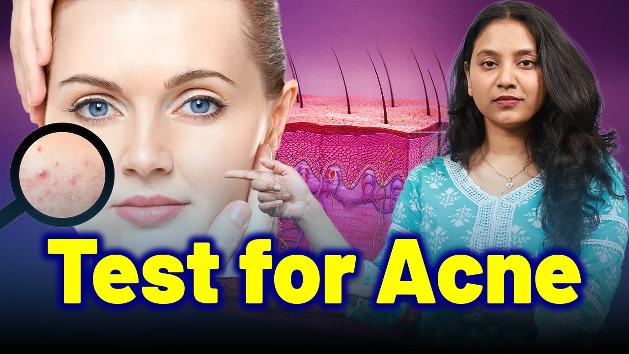 Important Test for Acne, Pimples ,Blackheads .| Treatment Cure Relief Medicine | Homeopathy