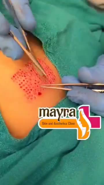 Transform Your Skin with Vitiligo Surgery: A Step Towards Confidence