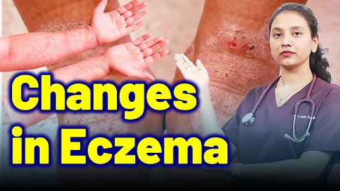 Body Changes in Eczema | Treatment Cure Relief Medicine | Skin Hair Nail | Homeopathy