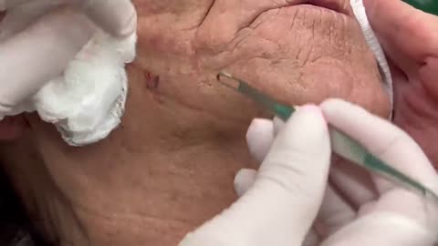 Leprechaun Blackheads