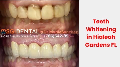 MSG Dental : #1 Teeth Whitening in Hialeah Gardens, FL | (786) 542-8954