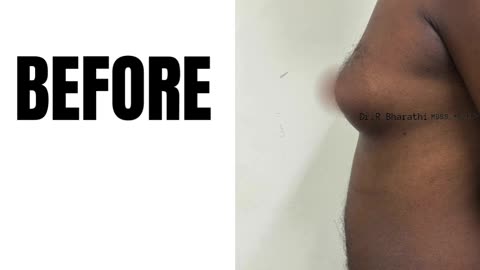 Gynecomastia Surgery in Chennai