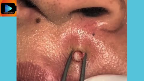 Satisfying Blackhead Removal – Looks Like a Giant Boiled Rice!