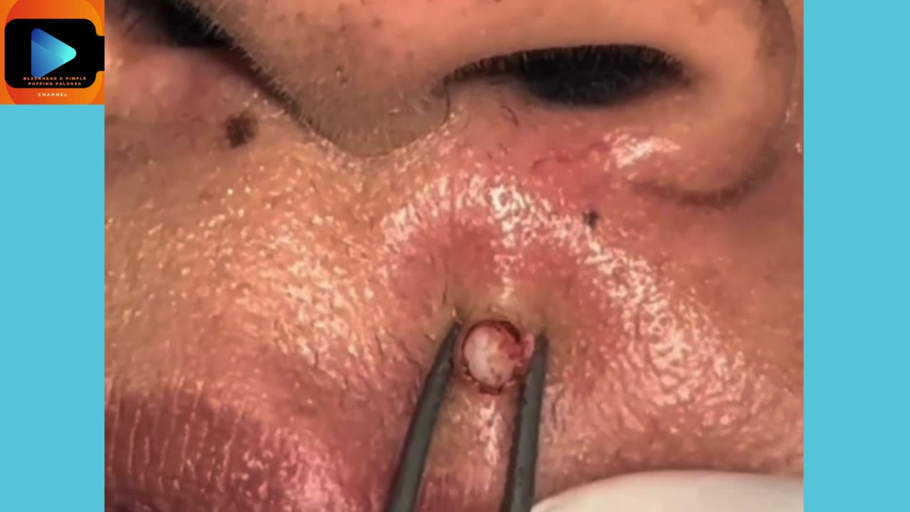 Satisfying Blackhead Removal – Looks Like a Giant Boiled Rice!