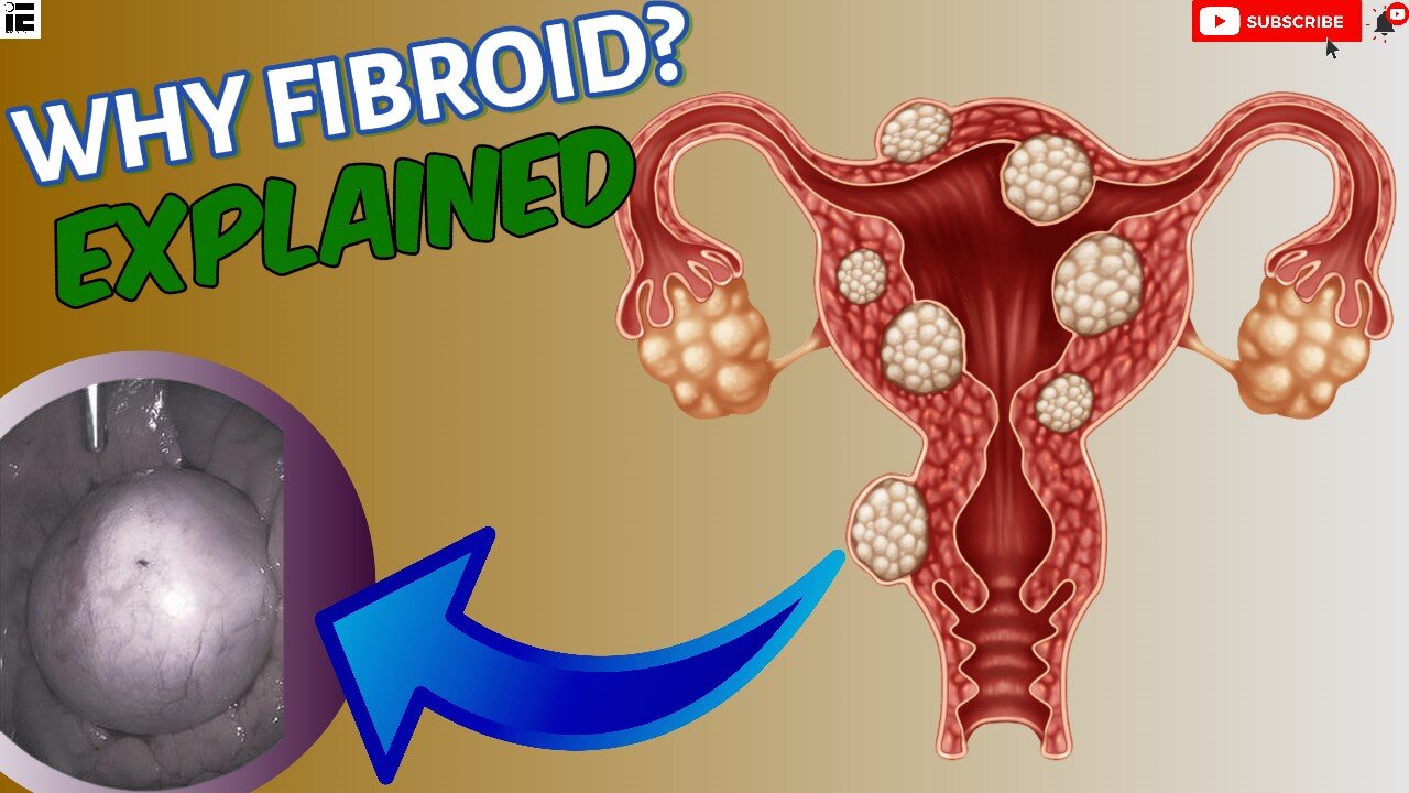 How Fibroids occur EXPLAINED