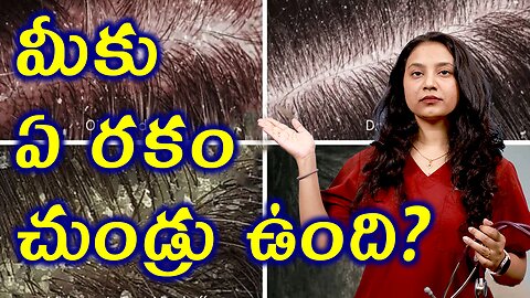 మీకు ఏ రకం చుండ్రు ఉంది? Types of Dandruff Control Treamtent Solution | హోమియోపతి