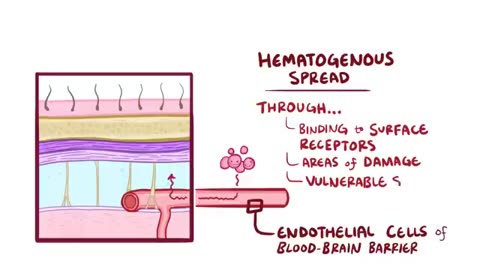 Meningitis - causes, symptoms, diagnosis, treatment, pathology
