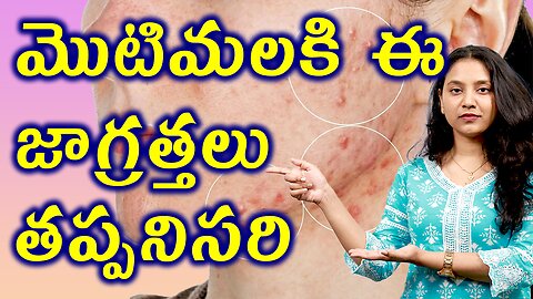 మొటిమలకి ఈ జాగ్రత్తలు తప్పనిసరి Precautions for ACNE or Pimples Treatment Cure | హోమియోపతి