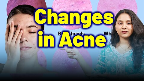 Changes in Acne, Pimples ,BlackHeads, WhiteHeads . | Treatment Cure Relief Medicine | Homeopathy