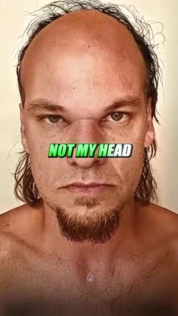 Theo Von on His Hair Transplant 😂 ft. Bert