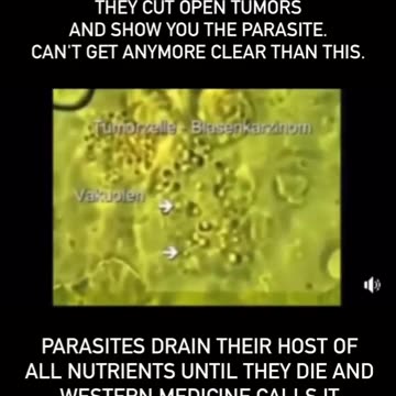 Parasites Cause Cancer Drs wont tell you