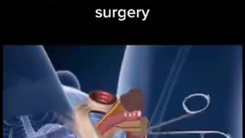 Gender Reassignment Surgery