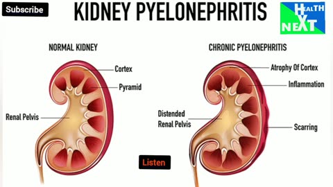 Pyelonephritis the dangerous UTi_Urinary Tract infection/Common Urinary problems.