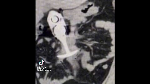 Patient Who Had A Metallic Sex Toy In Her Butt Gets Horribly Injured During An MRI Scan