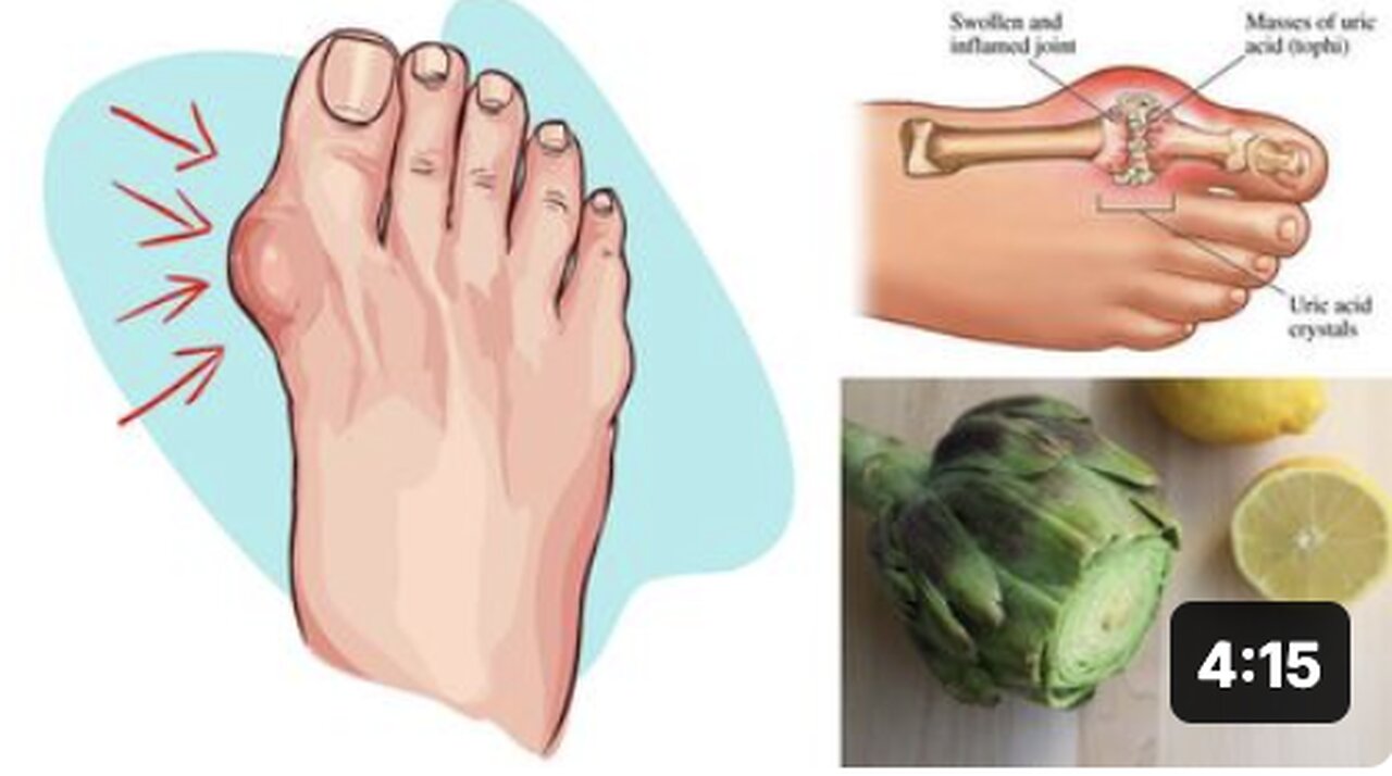 Eliminate Gout and High Uric Acid Levels With Artichoke and Lemon Water