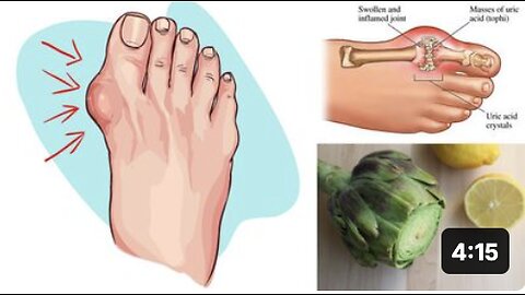 Eliminate Gout and High Uric Acid Levels With Artichoke and Lemon Water