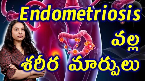 ఎండోమెట్రియోసిస్ వల్ల శరీర మార్పులు Changes in the Body due to Endometriosis Treatment | హోమియోపతి