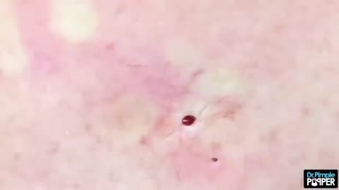 Some Spooky Blackheads