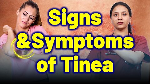 Signs & Symptoms of Tinea . | Treatment and Cure | Homeopathy, Medicine & Surgery