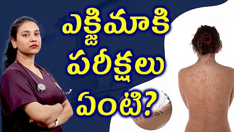 ఎక్జిమా కి పరీక్షలు ఏంటి? Tests and Investigations For Eczema Solution Treatment | హోమియోపతి