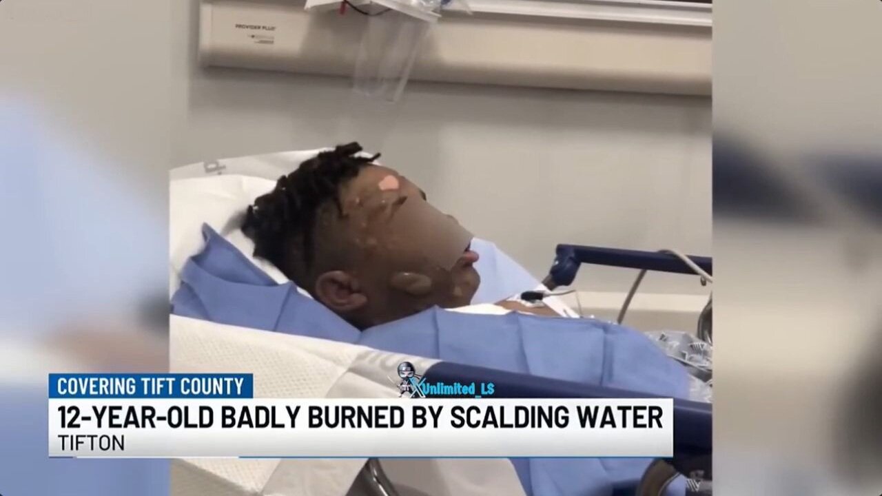 12-Year-Old Left With Severe Burns After Other Kids Poured Boiling Hot Water On Him During Sleepover