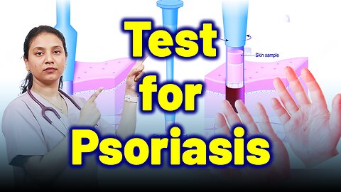 Test for Psoriasis. | Treatment and Cure | Homeopathy, Medicine & Surgery