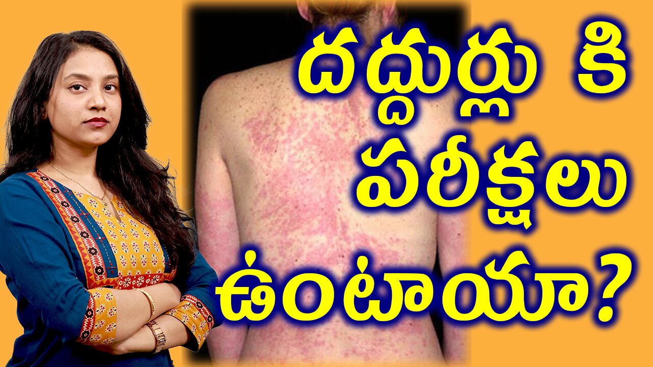 దద్దుర్లు కి పరీక్షలు ఉంటాయా? Tests and investigations for Urticaria Hives wheals | హోమియోపతి