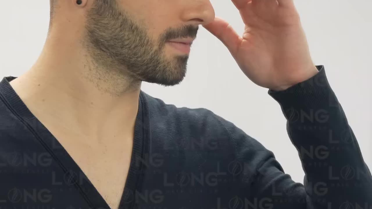 We take great care in achieving natural results in hair transplants.