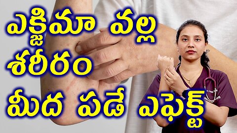 ఎక్జిమా వల్ల శరీరం మీద పడే ఎఫెక్ట్ Body Changes in Eczema Treatment Cure Medicine | హోమియోపతి