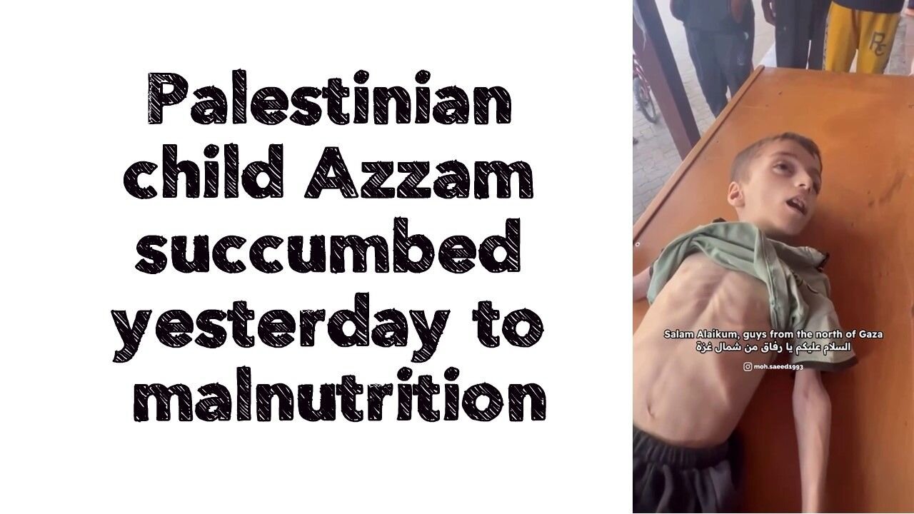 Palestinian child Azzam succumbed yesterday to malnutrition