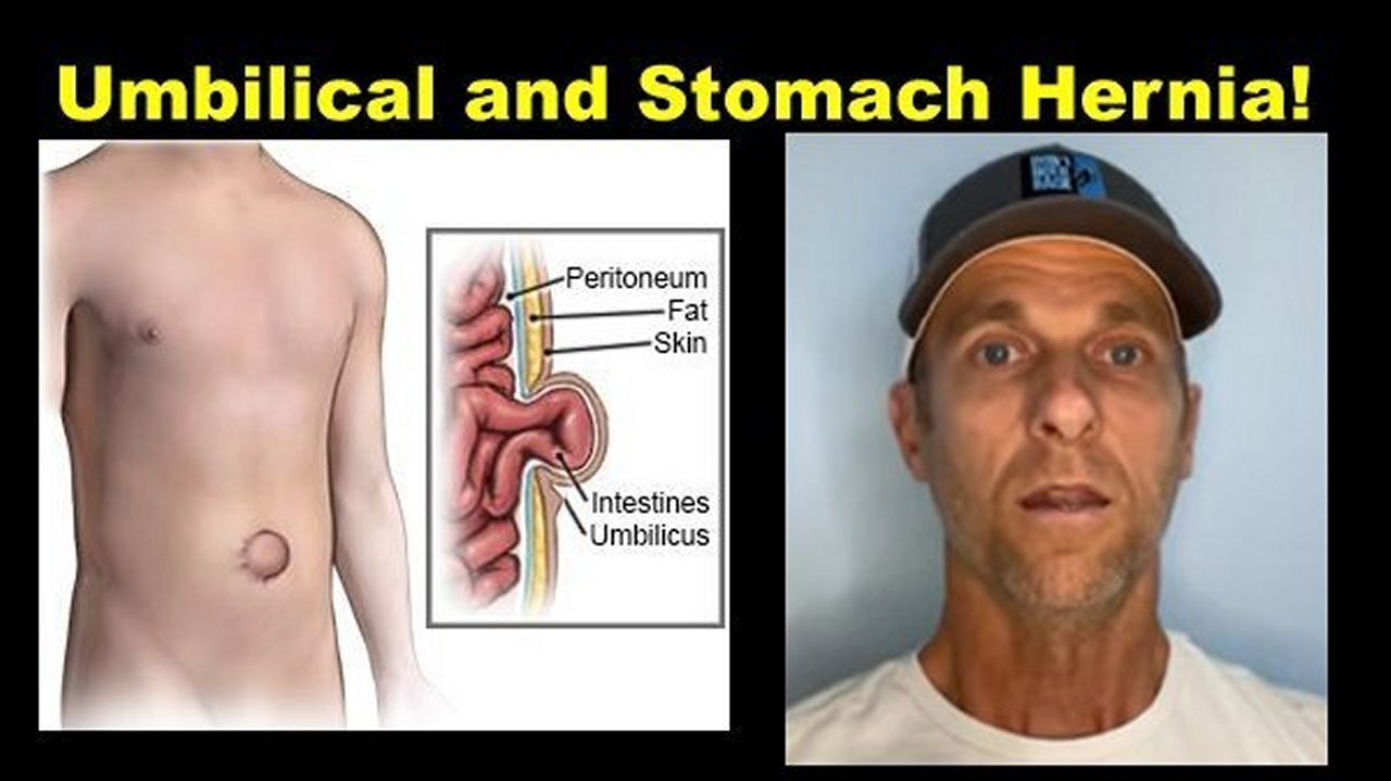 Kim Osbøl: Can you Treat Umbilical & Stomach Hernia Without Surgery? ? (Part 3)