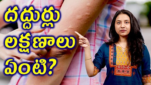 దద్దుర్లు లక్షణాలు ఏంటి? What is Urticaria and Signs and Symptoms of Urticaria or Hives | హోమియోపతి