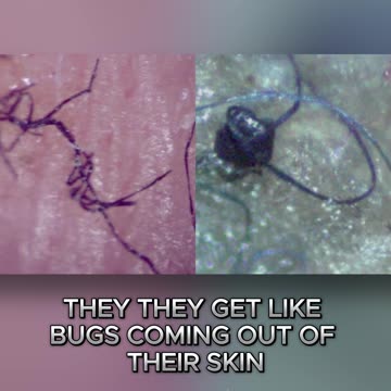 FDA Confirmed Morgellons as a Real Medical Condition!