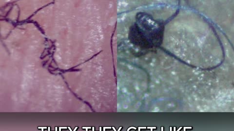 FDA Confirmed Morgellons as a Real Medical Condition!